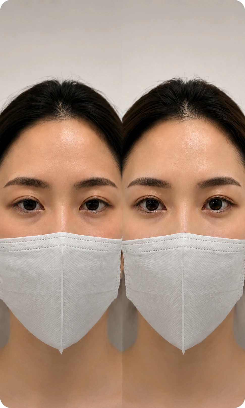 눈밑 지방 Before After